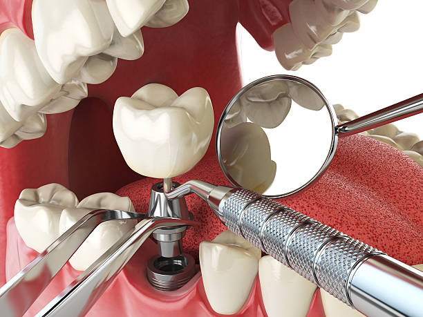 Best Emergency Dentist for Lost Fillings or Crowns in Moses Lake, WA